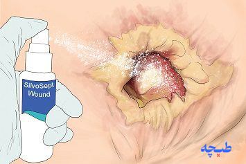روش استفاده از پانسمان حفره ای کیتوکاویتی