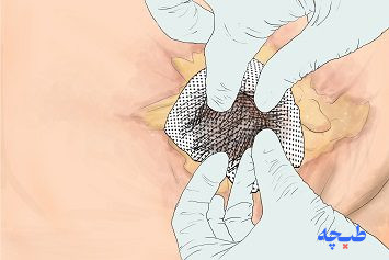 روش استفاده از پانسمان حفره ای کیتوکاویتی