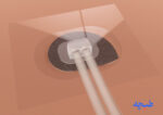 کیت وکیوم تراپی مارپیچی مخصوص Instillation  کانفورت - Image 2