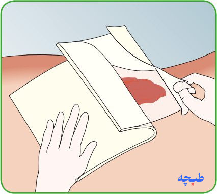 قرار دادن پانسمان مپیلکس ترانسفر روی بستر زخم