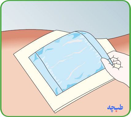 پوشاندن پانسمان مپیلکس ترانسفر با پانسمان ثانویه