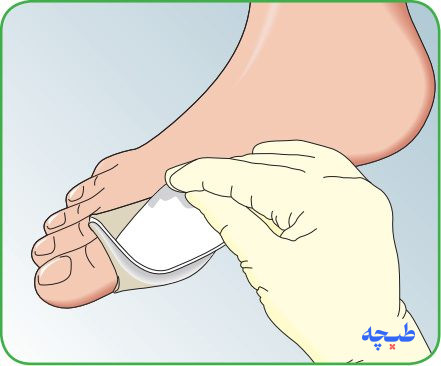 مرحله دوم قرار دادن پانسمان مپیلکس لایت روی زخم
