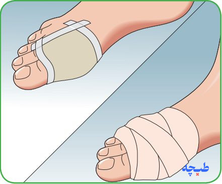 مرحله سوم ثابت کردن پانسمان مپیلکس لایت