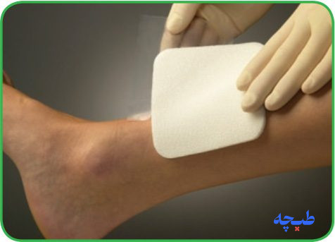 قرار دادن پانسمان مپیلکس روی زخم